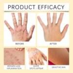Vitigo Bee Venom Treatment Cream | Natural Skin Repair Hydration Relief Anti-Irritation - Image 3
